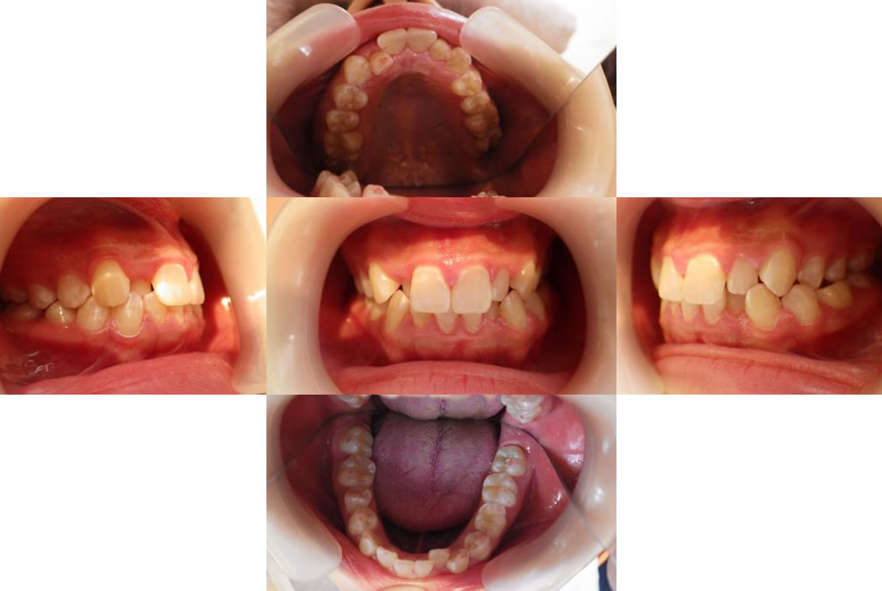 叢生のインビザライン治療例 21歳女性 治療期間12ヶ月 浦和もちまる歯科 矯正歯科クリニック